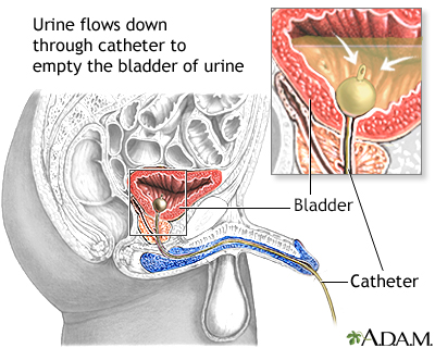 In Depth Reports Urinary Incontinence