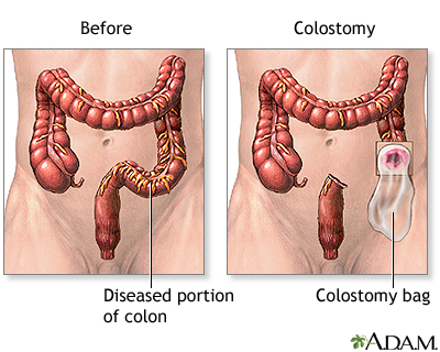 Hie Multimedia Colon And Rectal Cancer Colostomy Series