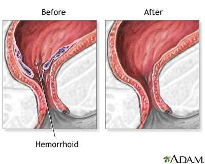 anal reconstruction of hemmoroids Hung and hairy