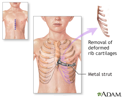 breast bone deformity Amateur redhead auditions trailers